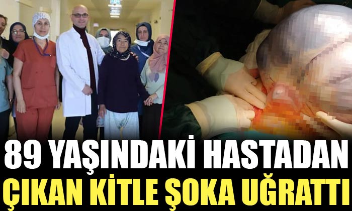 Karın Ağrısı ve Şişlik ile Hastaneye Başvuran 89 yaşındaki Hastanın Tetkiklerinde 35 cm Boyutunda Kitle Saptandı